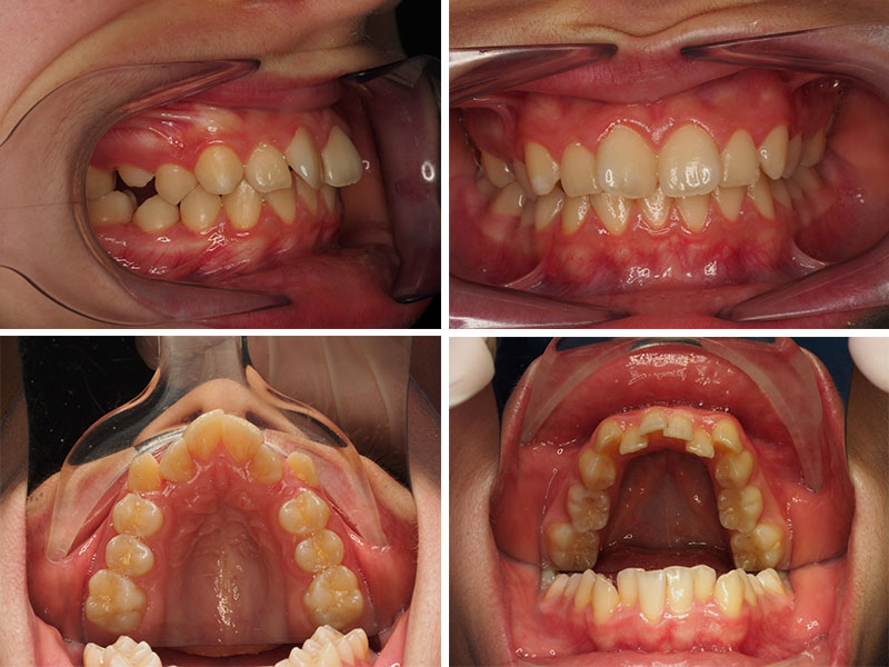 Fotografía intraoral ortodoncia