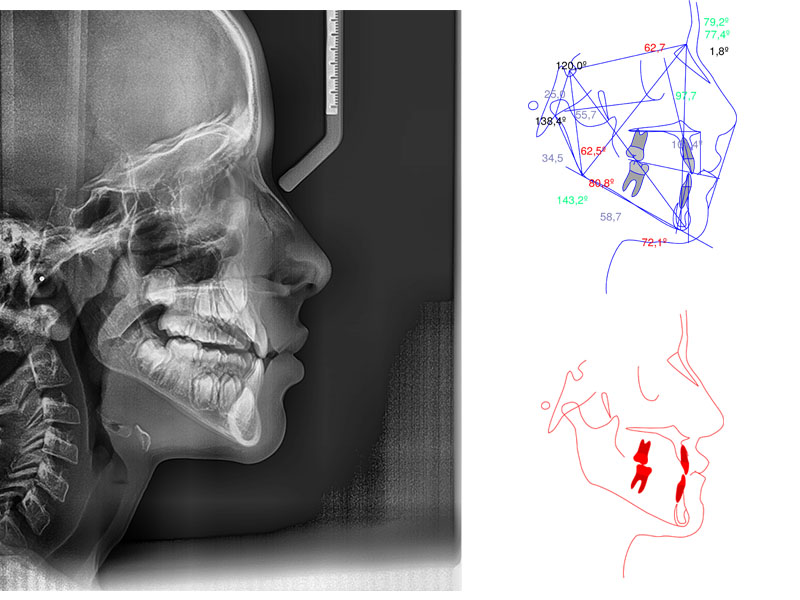 Radiografía lateral cráneo ortodoncia