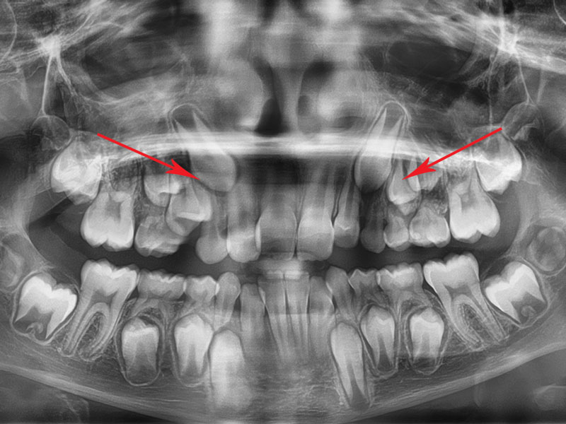Radiografía panorámica ortodoncia