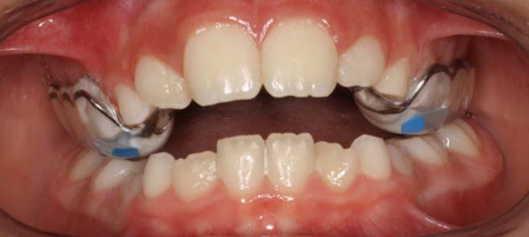 Tratamientos de ortodoncia en niños